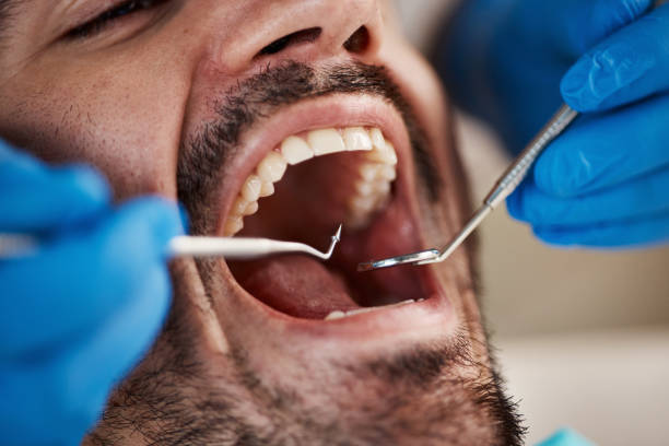 Best Knocked-Out Tooth (Avulsed Tooth) Treatment in Dimondale, MI